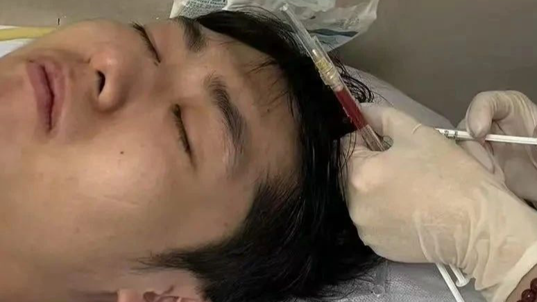 不是哥们，26 岁程序员，去种头发了？